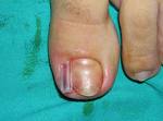 Tırnak Enfeksiyonunun Parmaklara Zararları