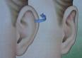 Kepçe Kulak Üst Kısım Estetiği